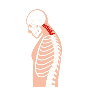 Neck vertebrae deformity Stock Illustration