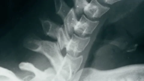 Neck x-ray close-up. Magnetic Resonance Image of Spinal Column, Skull Head Stock Footage 169196841