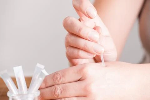 Needeling acupuncture 스톡 사진