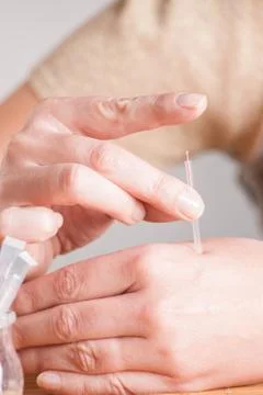 Needeling acupuncture Stock Photos