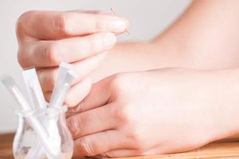 Needeling acupuncture Stock Photos
