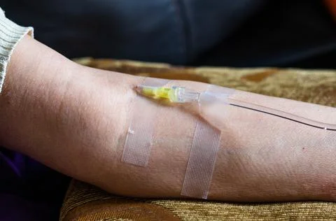 The needle of the drip stands in the vein for the introduction of vitamins Stock Photos