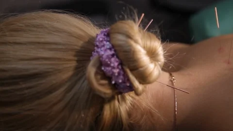 Needles on a woman's back.Dry needling.Trigger point therapy.Dry needling Stock Footage 116663972