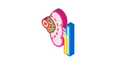 Nephrectomy surgery isometric icon animation Stock Footage 327283114