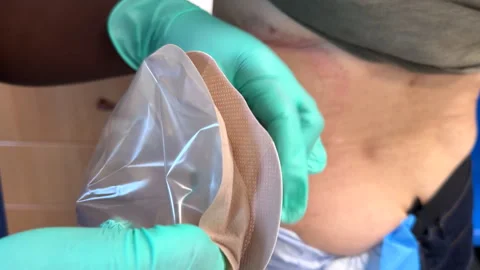 Nephrostomy drainage pouch or bag fitting close up Stock Footage 340517098