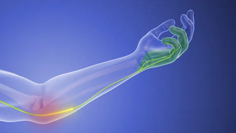 Nerve Compression Issues in Cubital Tunnel Syndrome Vidéo 299783345