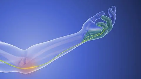Nerve Compression Issues in Cubital Tunnel Syndrome Stock Illustration