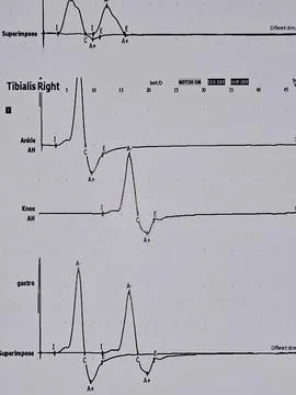 Nerve conduction study Electrophysiological studies for both LL lower limbs.. Foto stock