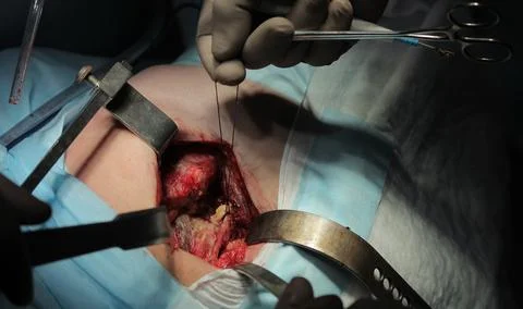 Nerve In Hip Surgery Stockfoto's