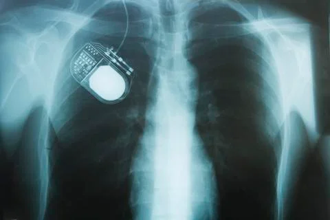 Nerve stimulator, x-ray Stock Photos