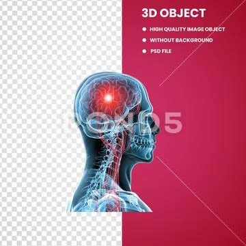 Nerve-Traumatic-brain-injury-Concussion PSD Template