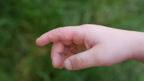 Nettle rash on small kid hand Stock Footage 107012126