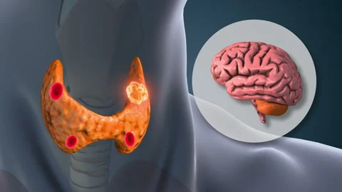 Neurological Effects of Hyperparathyroidism on Human Brain Stock Footage 317601989