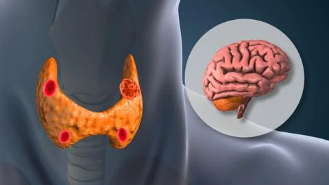 Neurological Effects of Hyperparathyroidism on Human Brain Stock Illustration