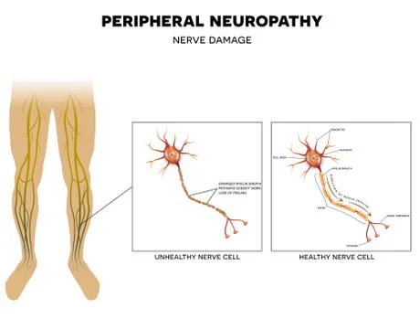 Neuropathy, nerve damage Stock Illustration