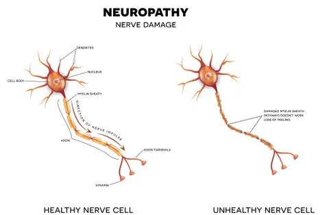 Neuropathy, nerve damage Illustrazione stock
