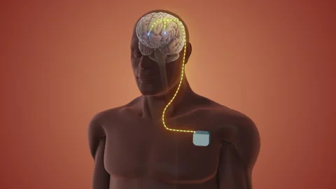 Neurostimulator Sending Electrical Brain Impulses Vídeos de archivo 329097644