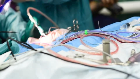 Neurosurgeons perform surgery to excise a brain tumor Stock-Footage 103103088