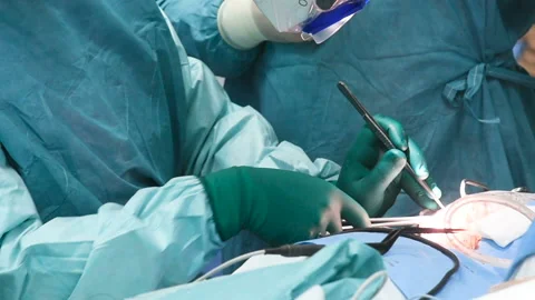 Neurosurgeons perform surgery to excise a brain tumor Stock Footage 103103524