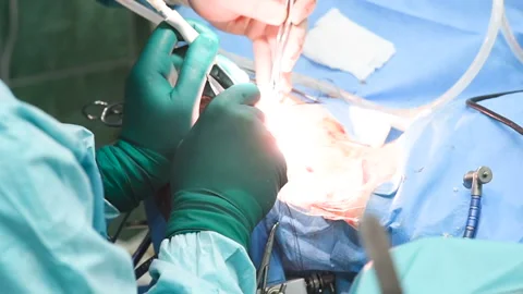 Neurosurgeons perform surgery to excise a brain tumor Stock-Footage 103104082