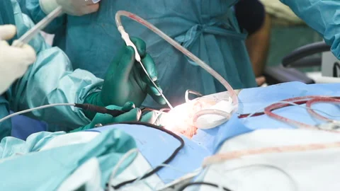 Neurosurgeons perform surgery to excise a brain tumor Stock-Footage 108620237