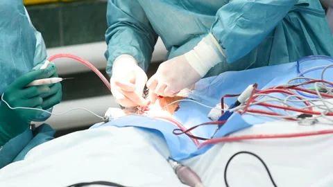 Neurosurgeons perform surgery to excise a brain tumor Video stock 116997269