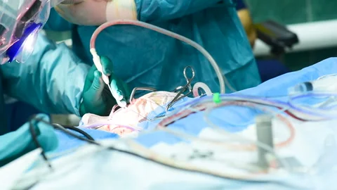 Neurosurgeons perform surgery to excise a brain tumor Video stock 116997325