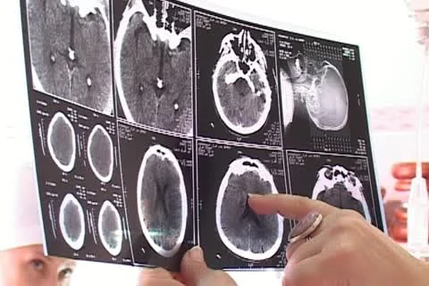 Neurosurgical Stock Footage 12289372