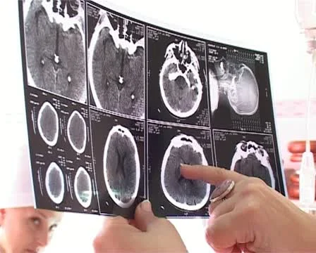 Neurosurgical Stock-Footage 12289376