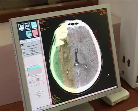 Neurosurgical Stock Footage 12289446