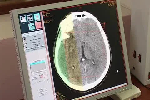 Neurosurgical Stock-Footage 12289455