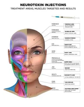Neurotoxin injections Stock Illustration