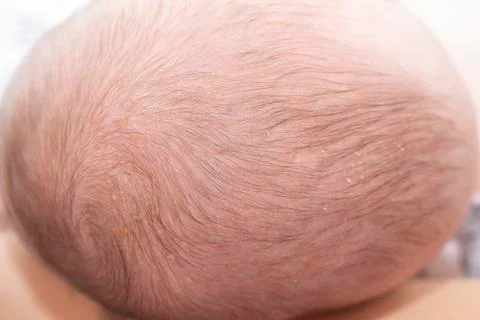 Newborn head with cradle cap Stock Photos