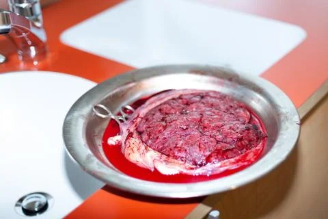 Newborn human placenta Foto stock