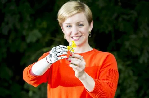 Nicky Ashwell 29 With Her New 'bionic' Arm - A Small Prothesis With Articulated  Stock Photos