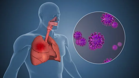 Nipah Virus Infection Growing Inside Human Lungs Stock Footage 329553747