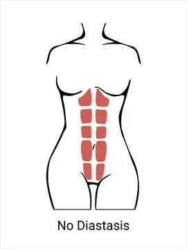 No Diastasis Stock Illustration