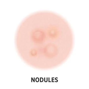 Nodules skin acne type vector icon. Skin disease acne nodules pimples type an Illustrazione stock