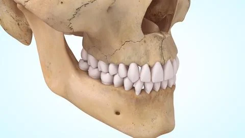 Non-displaced maxilla (upper jaw) fracture of 3d illustration Stock Illustration