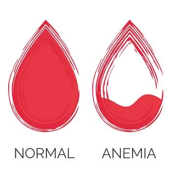 Normal and anemic drop of blood. Lack of red cells, anemia. Isolated on white Stock Illustration