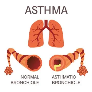 Normal and asthmatic bronchioles Stock Illustration