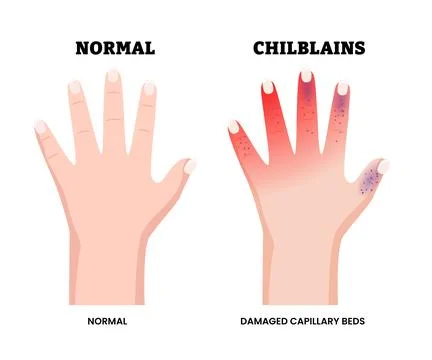 Normal and Chilblains Hand Condition Symptoms Medical Illustration. Showing.. Stock Illustration