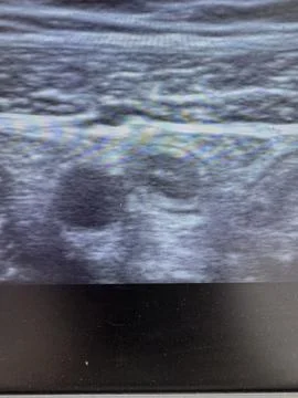 Normal Appendix Ultrasound  High-Resolution Imaging N29 V24 Foto stock