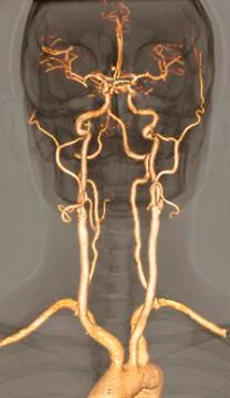Normal arteries, 3d ct scan Stock Illustration