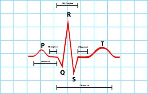 Normal Atrial And Ventricular Depolarization With Electrocardiogram Description Stock Illustration