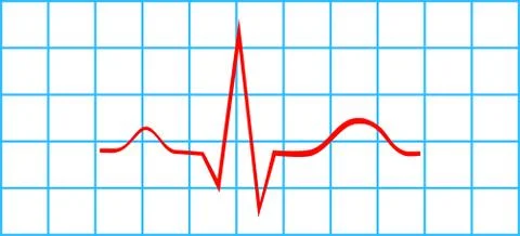 Normal Atrial And Ventricular Depolarization On Electrocardiogram Stock Illustration