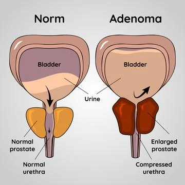 Normal bladder and BPH problem, prostate adenoma medical vector illustration Stock Illustration