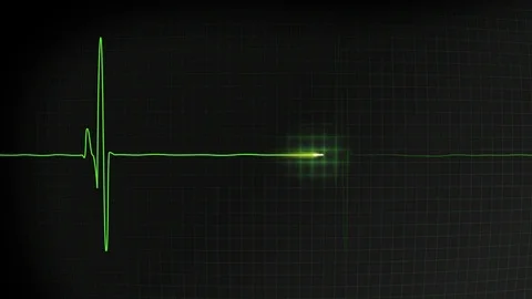 Normal heart pulse monitored on hospital EKG display loop Stock Footage 77696751