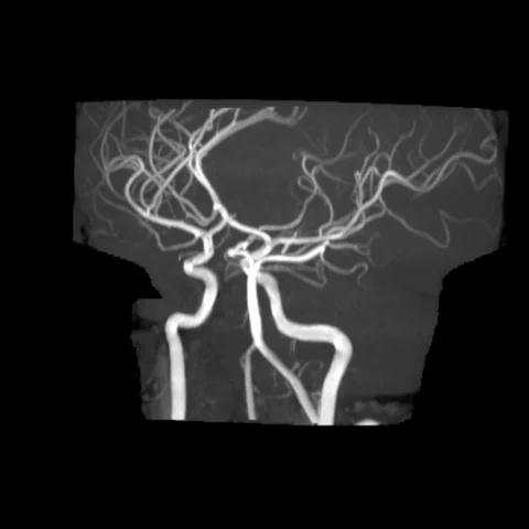 Normal Intracranial MRA with MIP Stock Footage 113240141