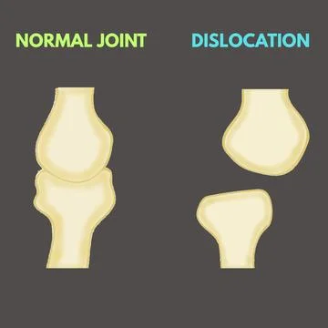 NORMAL JOINT VERSUS DISLOCATION Stock Illustration